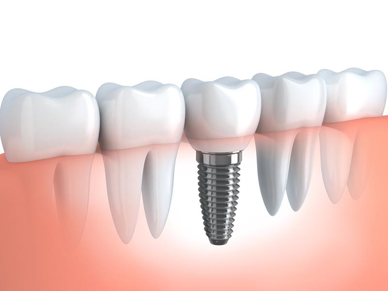 Dental Implants Lethbridge, AB